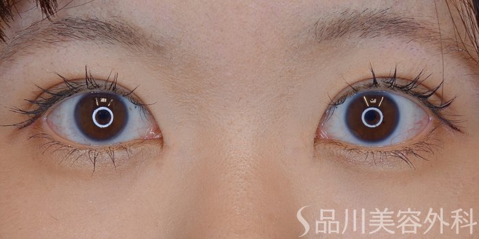 症例NO.71658のAFTER写真