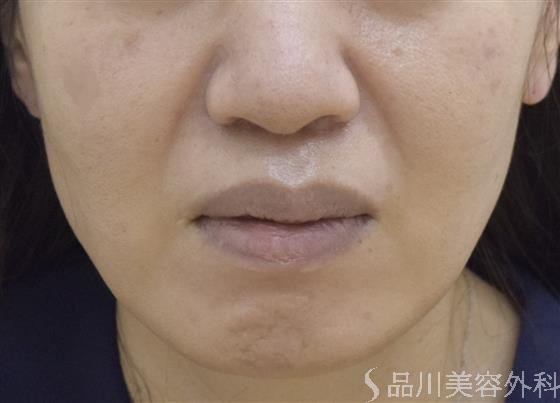 症例NO.51623のBEFORE写真