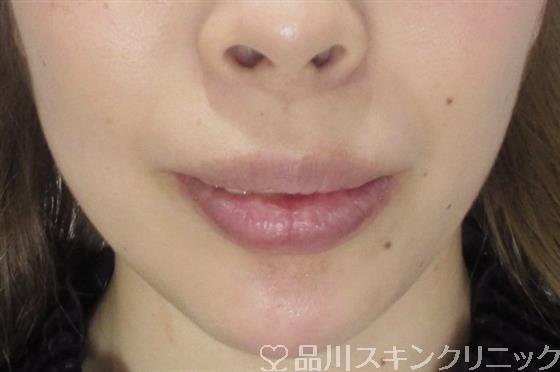 症例NO.35177のAFTER写真