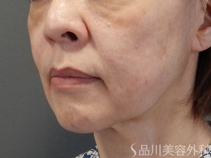 症例NO.70383のBEFORE写真
