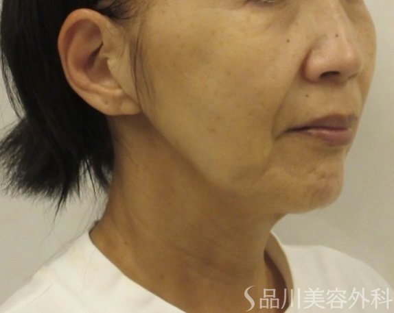 症例NO.74758のBEFORE写真