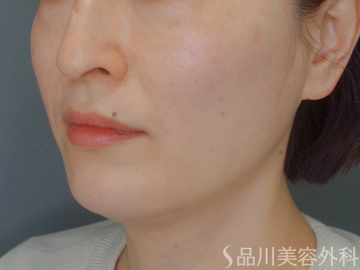 症例NO.73484のAFTER写真