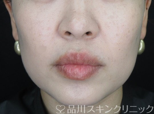 症例NO.69785のAFTER写真
