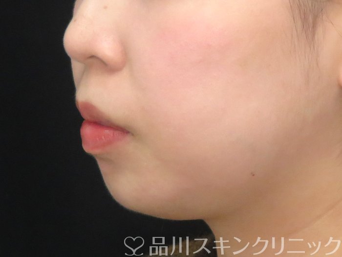 症例NO.67593のAFTER写真