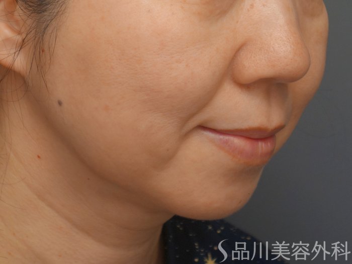 症例NO.69319のBEFORE写真