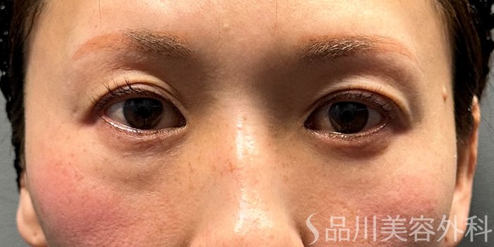 症例NO.69501のBEFORE写真