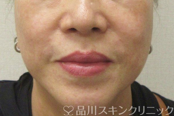 症例NO.75224のAFTER写真