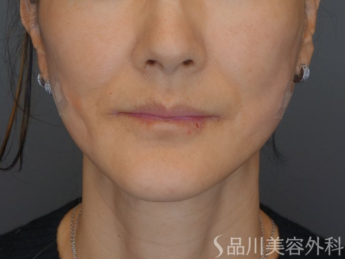 症例NO.72926のAFTER写真