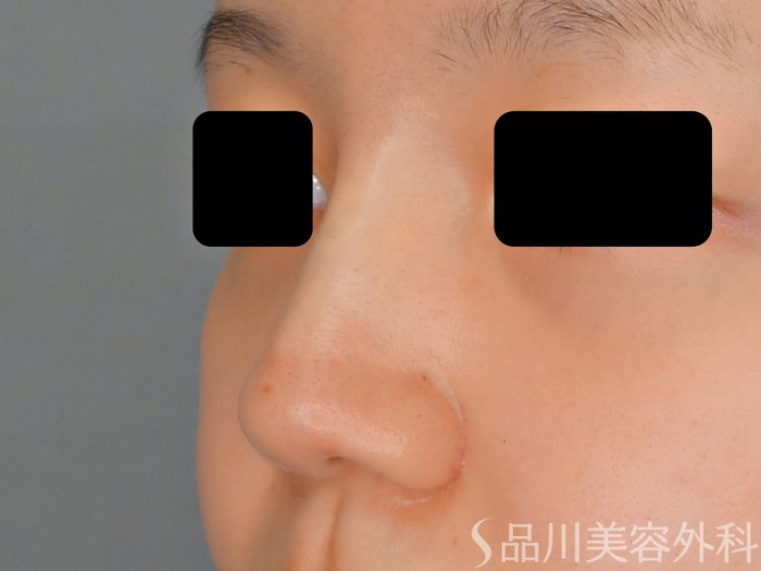 症例NO.70911のAFTER写真