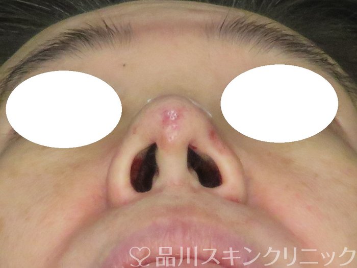 症例NO.65661のAFTER写真