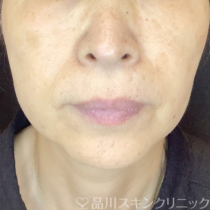 症例NO.62566のBEFORE写真