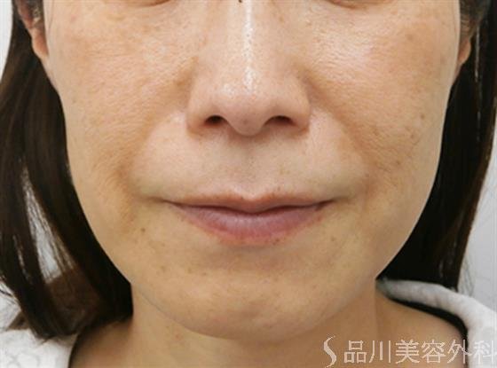 症例NO.31581のAFTER写真