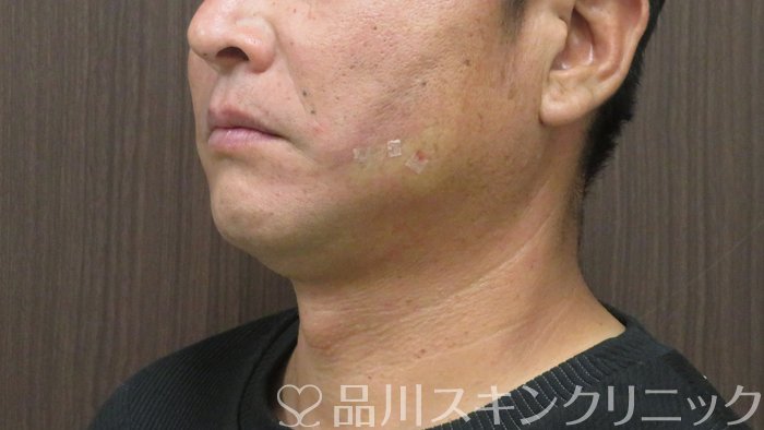 症例NO.72371のAFTER写真