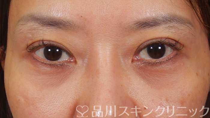 症例NO.62459のAFTER写真