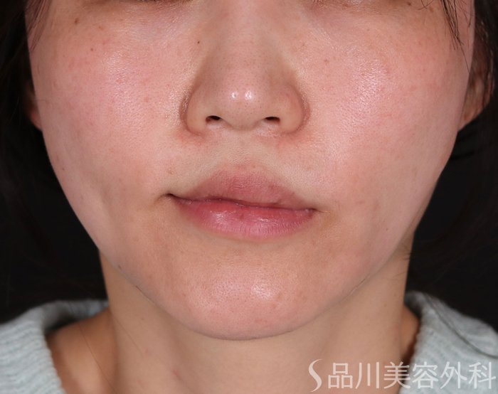 症例NO.73116のAFTER写真