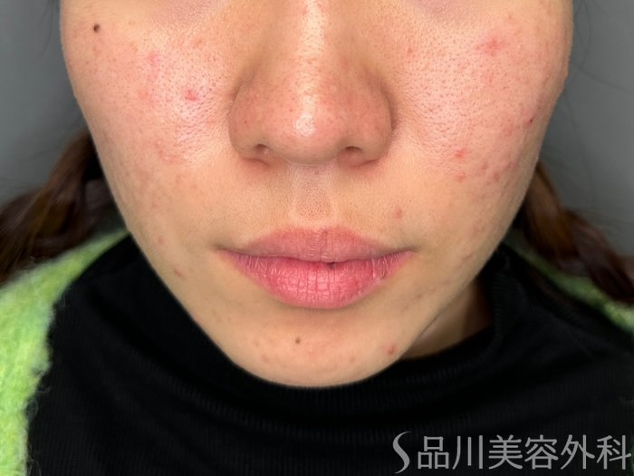 症例NO.65669のBEFORE写真