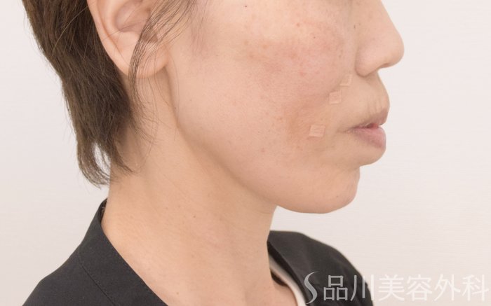 症例NO.71437のAFTER写真