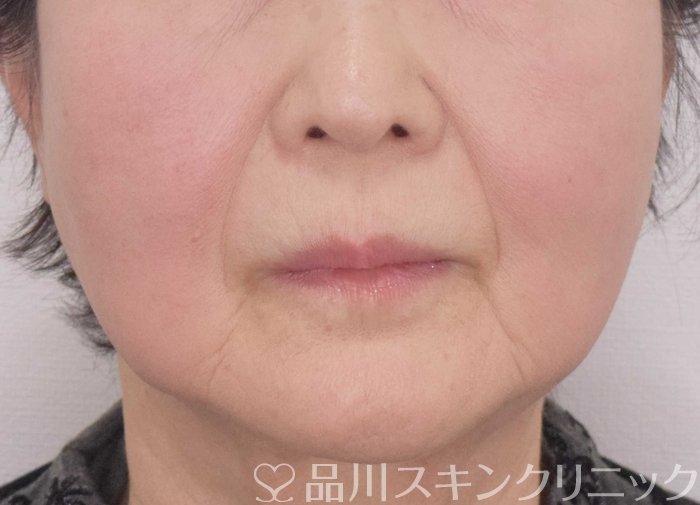 症例NO.69886のBEFORE写真