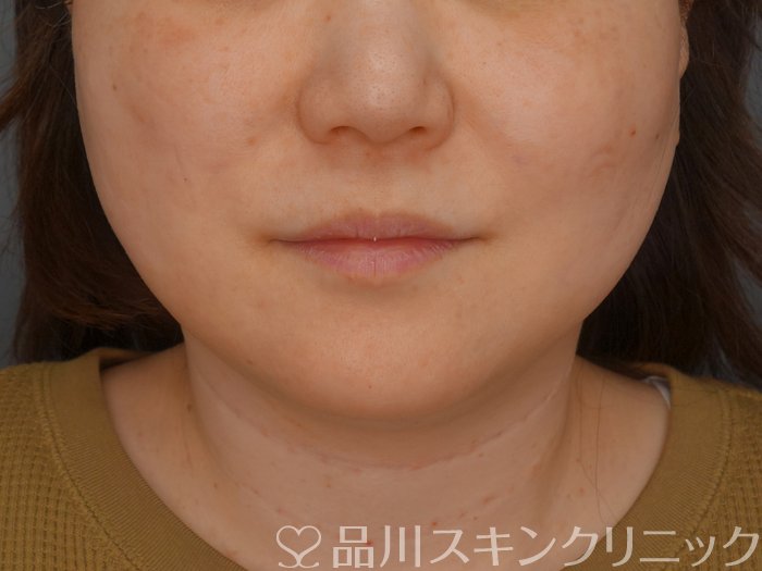 症例NO.72994のAFTER写真