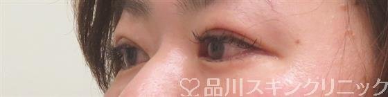 症例NO.56267のAFTER写真