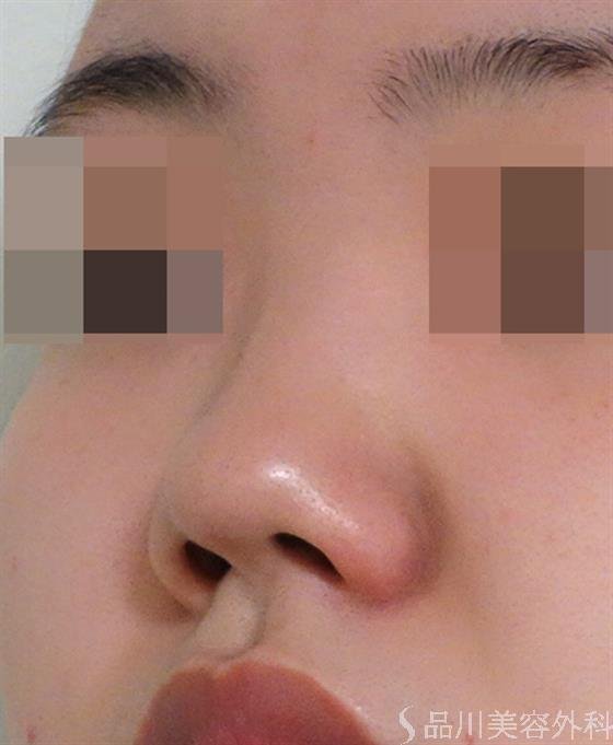 症例NO.40272のBEFORE写真
