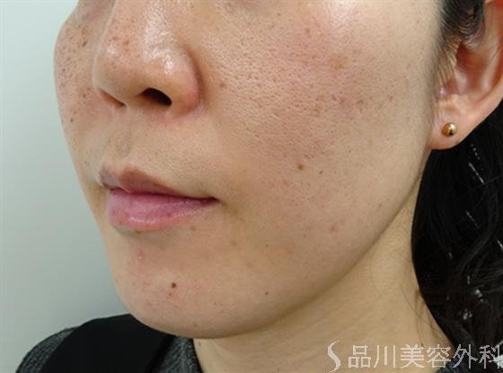 症例NO.46675のBEFORE写真
