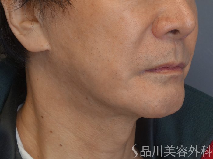 症例NO.72093のBEFORE写真