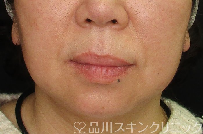 症例NO.70290のBEFORE写真