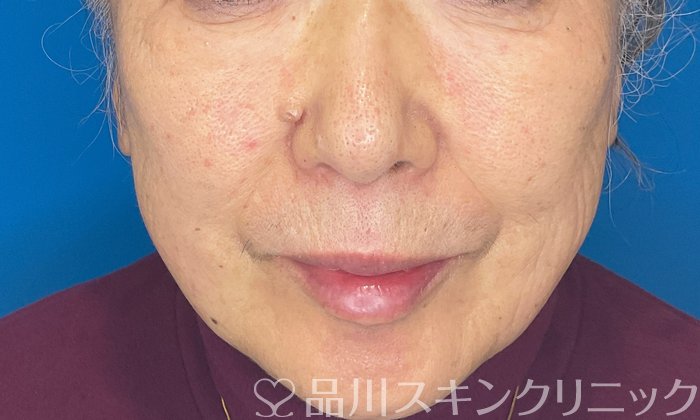 症例NO.74855のAFTER写真