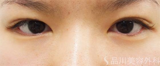 症例NO.33250のBEFORE写真