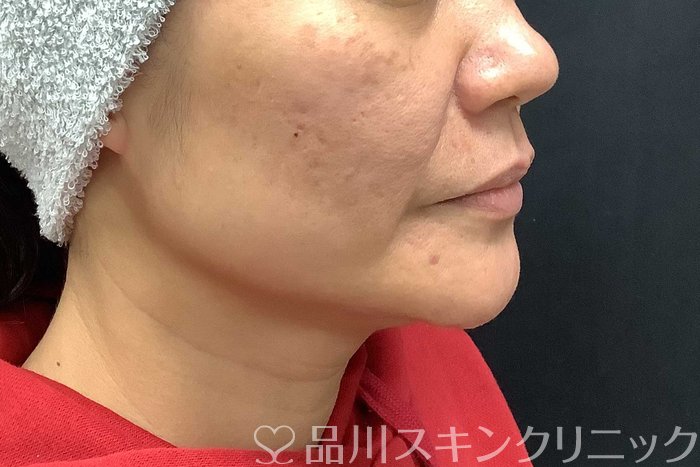 症例NO.69667のBEFORE写真