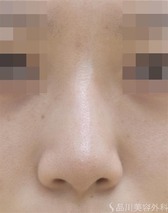 症例NO.44619のAFTER写真
