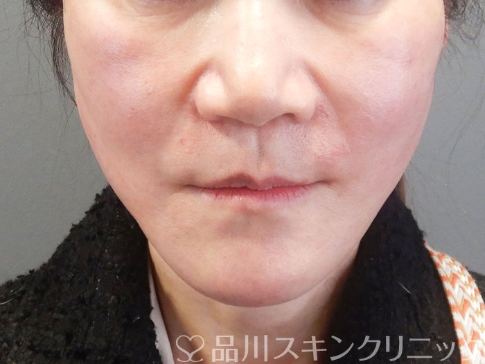 症例NO.73576のAFTER写真