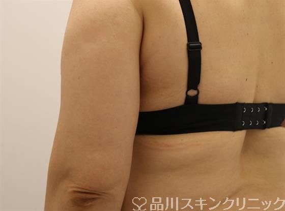 症例NO.43794のBEFORE写真