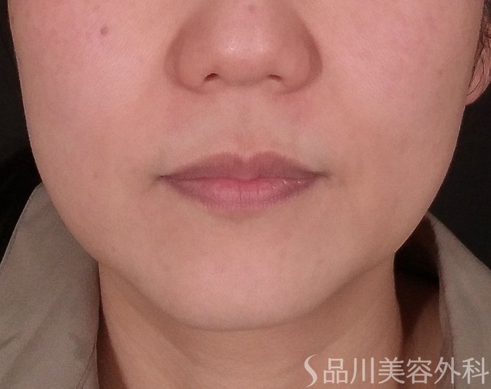 症例NO.69984のBEFORE写真