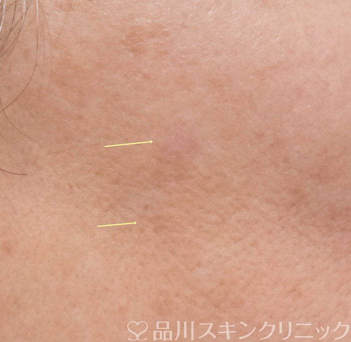 症例NO.70170のAFTER写真