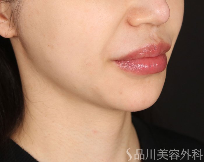 症例NO.73534のBEFORE写真