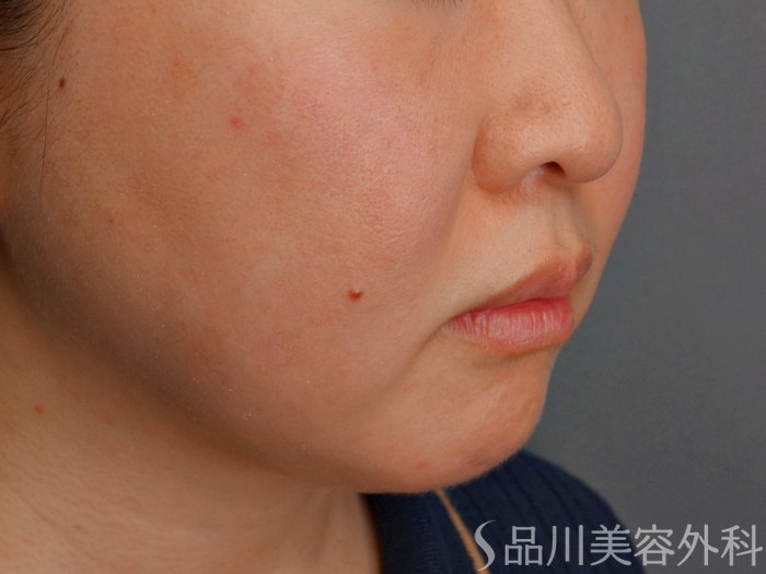 症例NO.73744のBEFORE写真