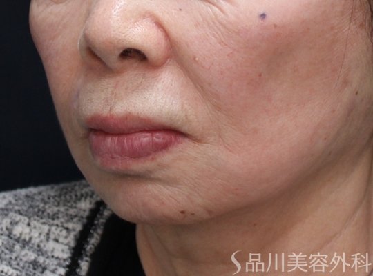 症例NO.73761のAFTER写真