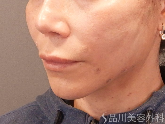 症例NO.69871のAFTER写真