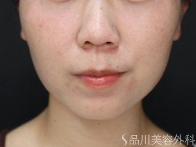 症例NO.75156のAFTER写真