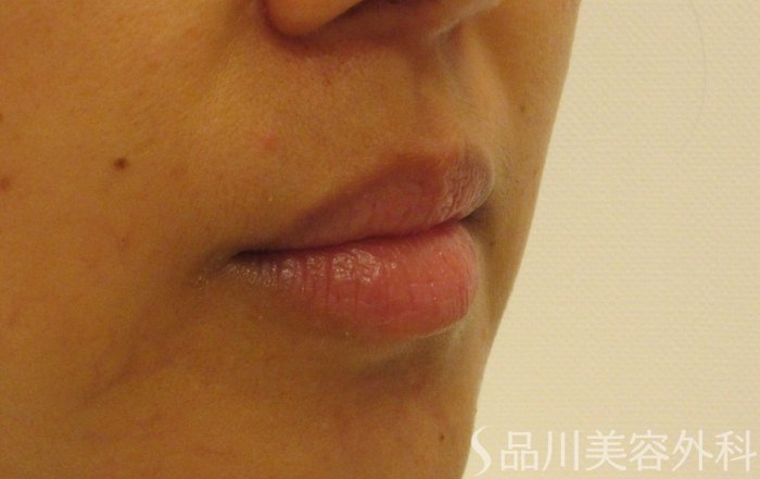 症例NO.70844のBEFORE写真