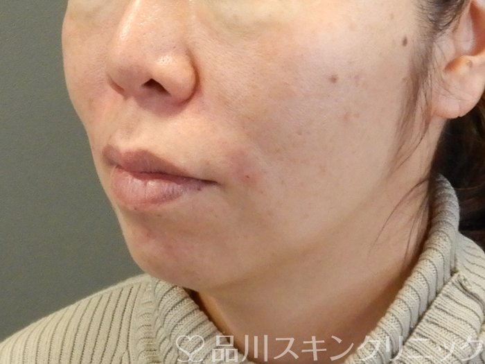 症例NO.63525のAFTER写真