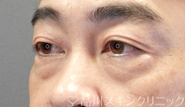 症例NO.65423のBEFORE写真