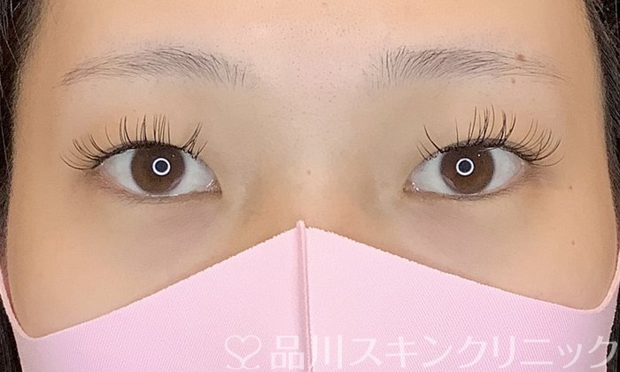 症例NO.70376のBEFORE写真