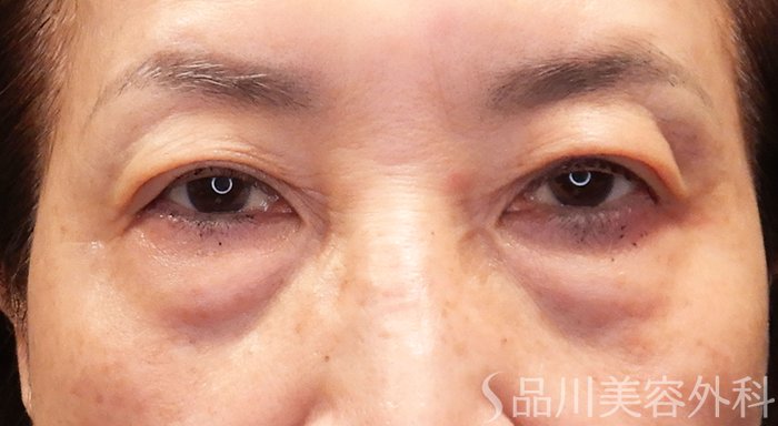 症例NO.70931のBEFORE写真