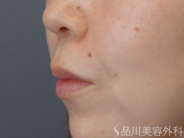 症例NO.72592のAFTER写真