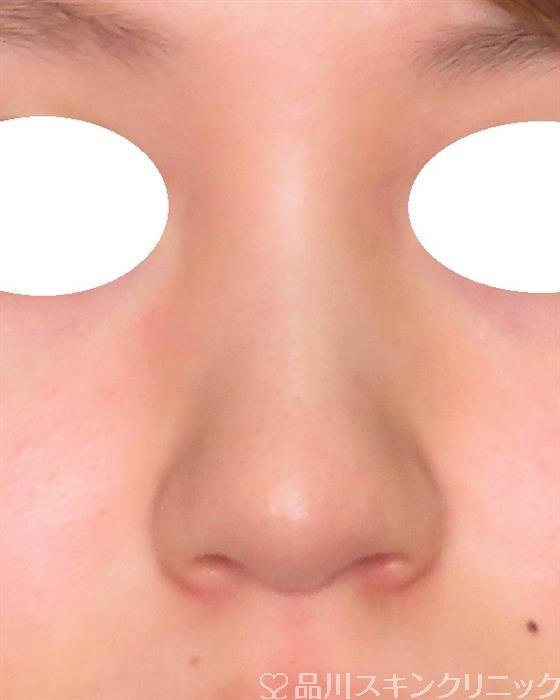 症例NO.49111のBEFORE写真