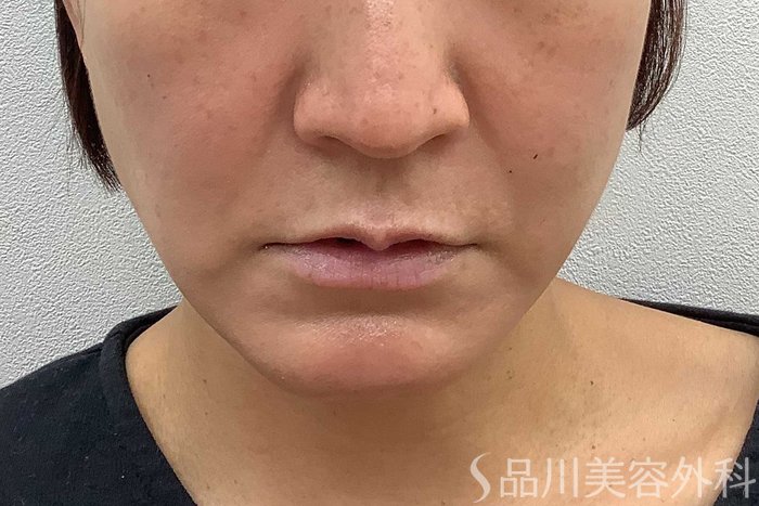 症例NO.62066のBEFORE写真