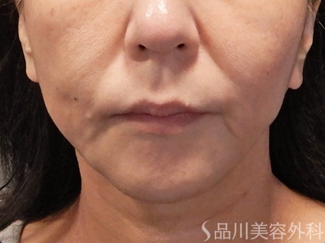 症例NO.72789のAFTER写真